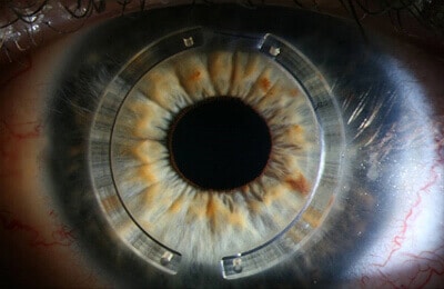 corneal implants