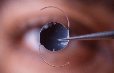 Toric IOL for Cataract Surgery