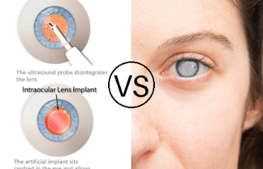 Lens Replacement Problems vs Benefits