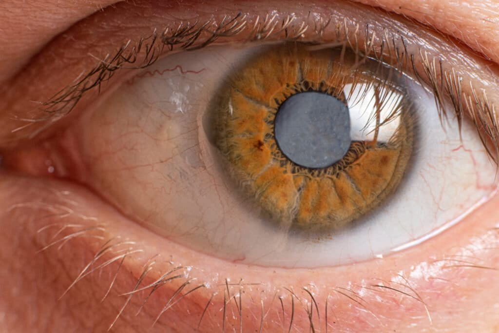 Close-up of the human eye - cataract clouding of the lens.