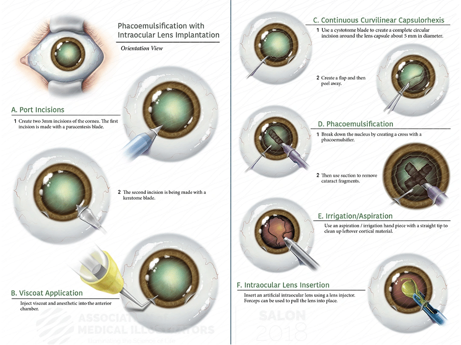 Procedures Are Performed of cataract and lens replacement