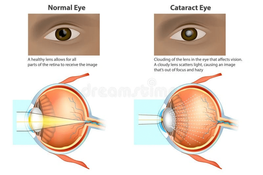 Understanding the Healing Process of cataract surgery