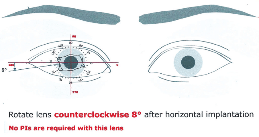 What are implantable contact lenses and how do they work