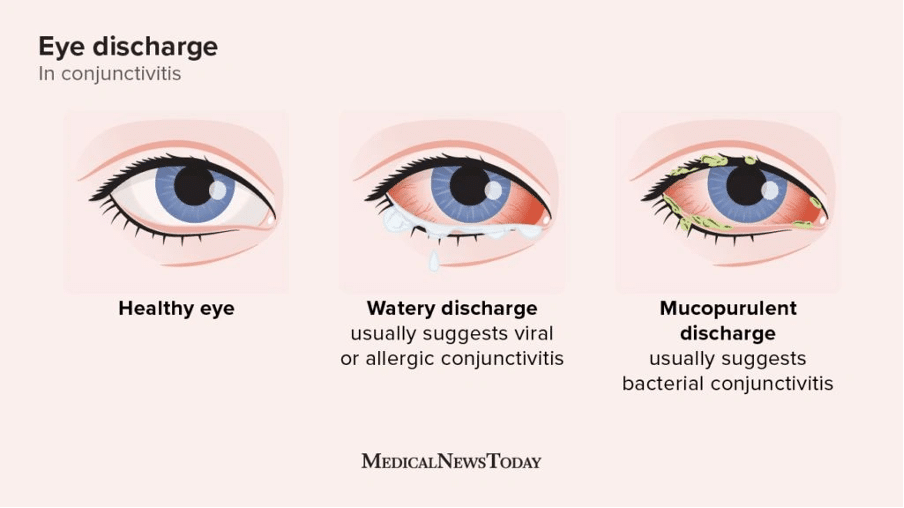 What are seasonal allergies and how do they affect the eyes?