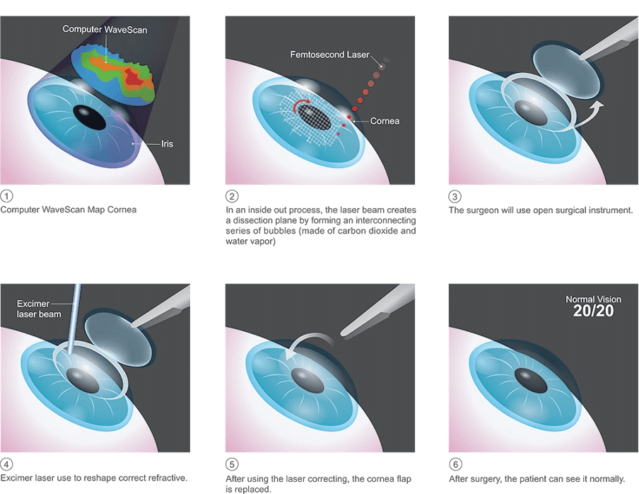What to expect before, during and after the procedure