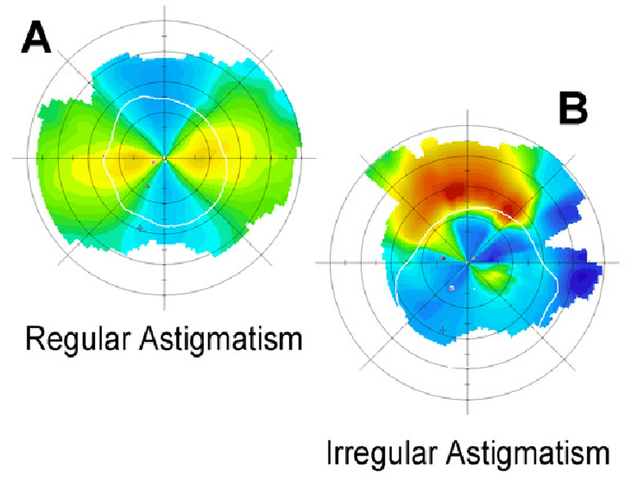 Astigmatism