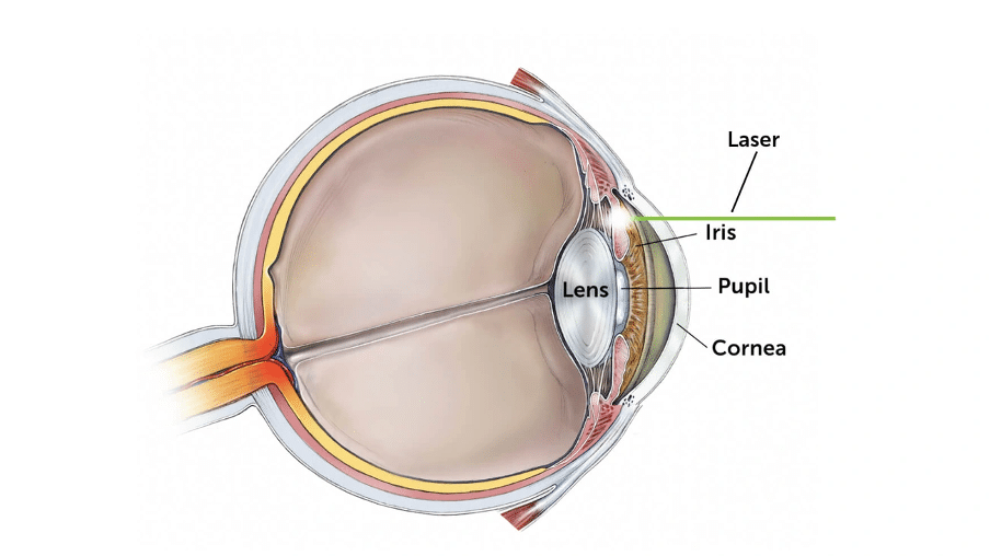 Common Complications and Their Causes laser eye surgery