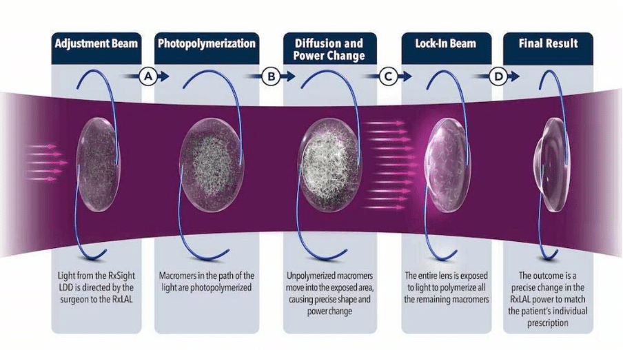 How the Light Adjustable Lens Procedure Works