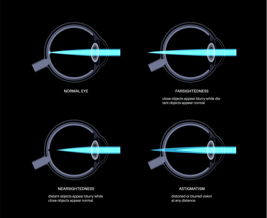 Understanding Astigmatism