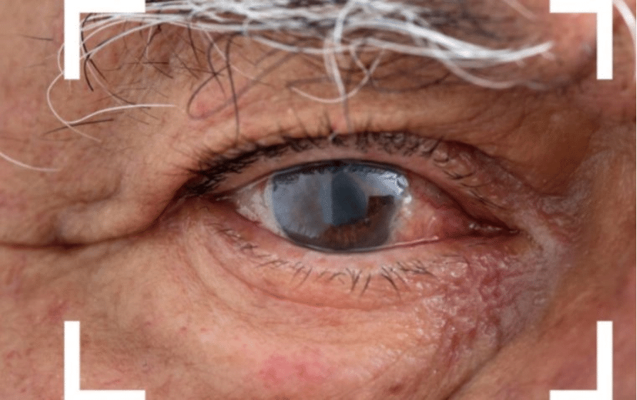 What happens if you skip your prescribed eye drops?