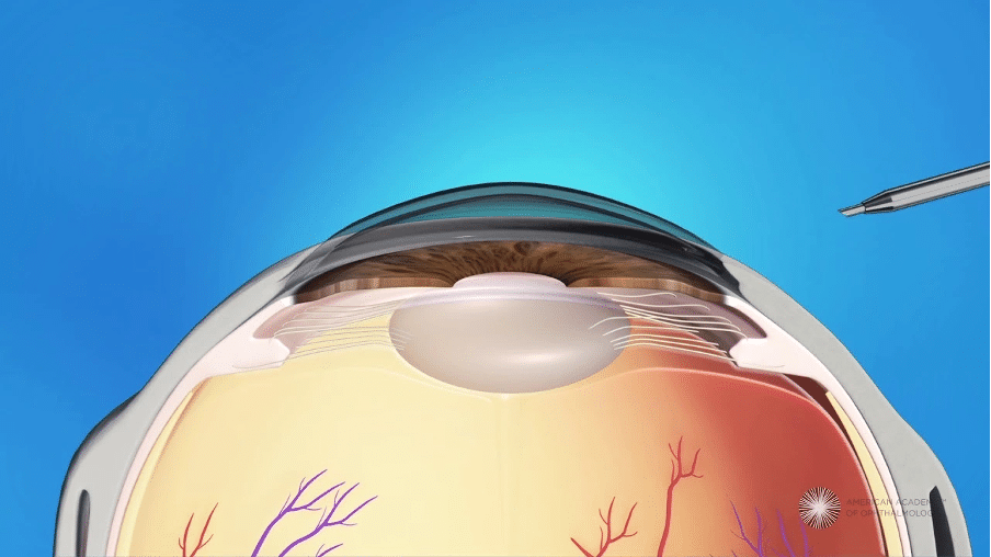 What is lens replacement surgery