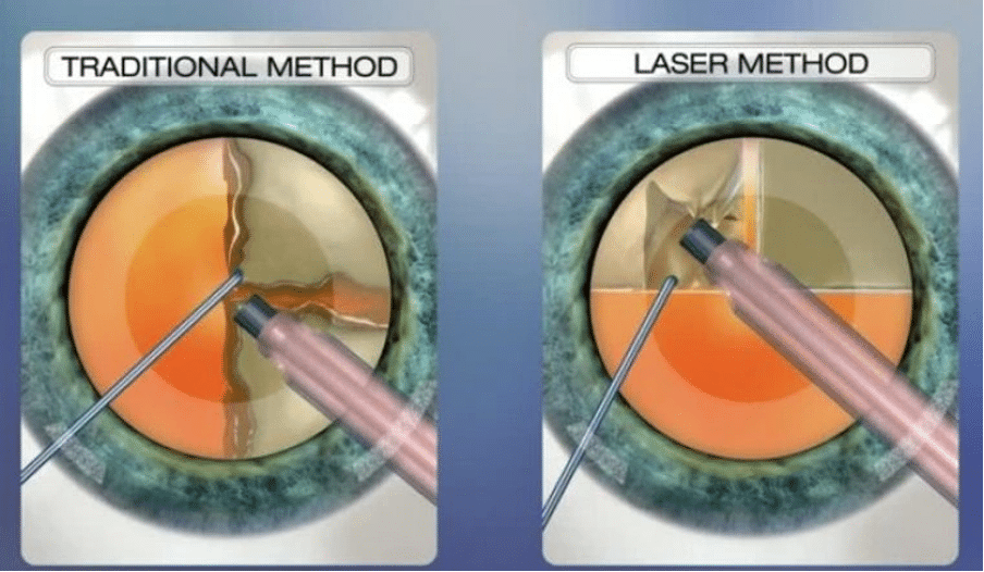 How Each Surgery Works Laser Assisted vs Traditional Cataract Surgery