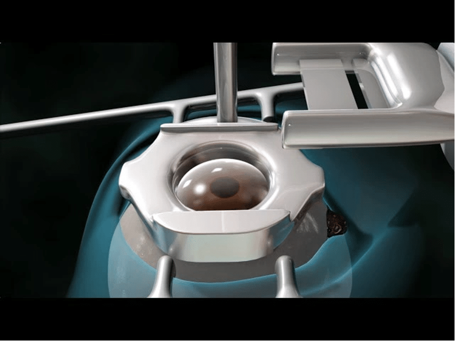How modern LASIK technology handles eye movement
