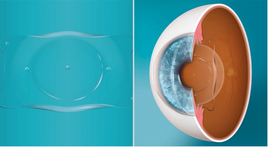 Recovery, Cost, and Patient Experience at Precision Vision London