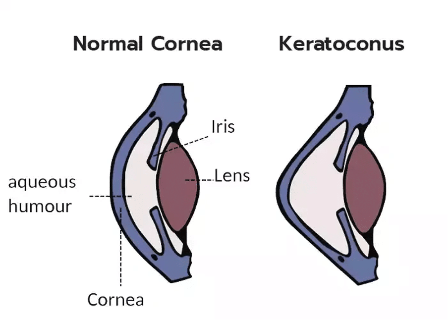 normal and Keratoconus eye difference