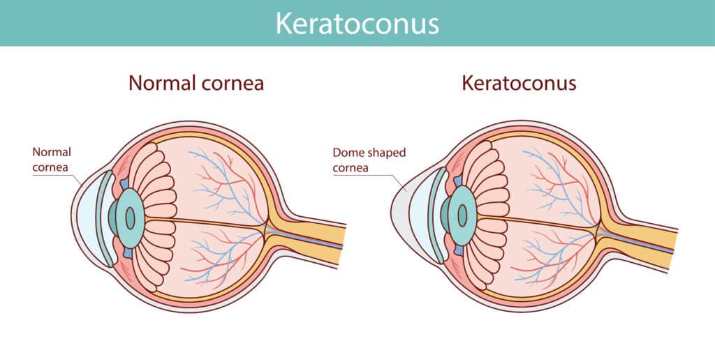 What is keratoconus and how it progresses